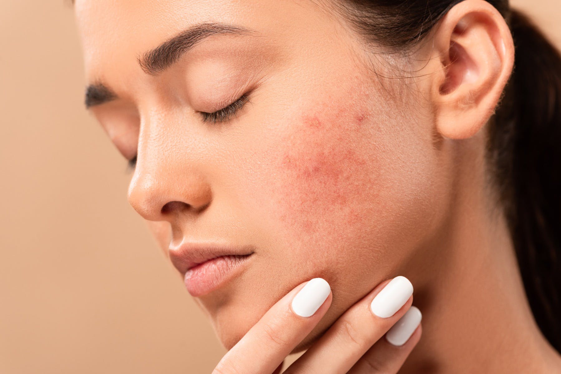 How to Fight Dark Spots on Your Skin